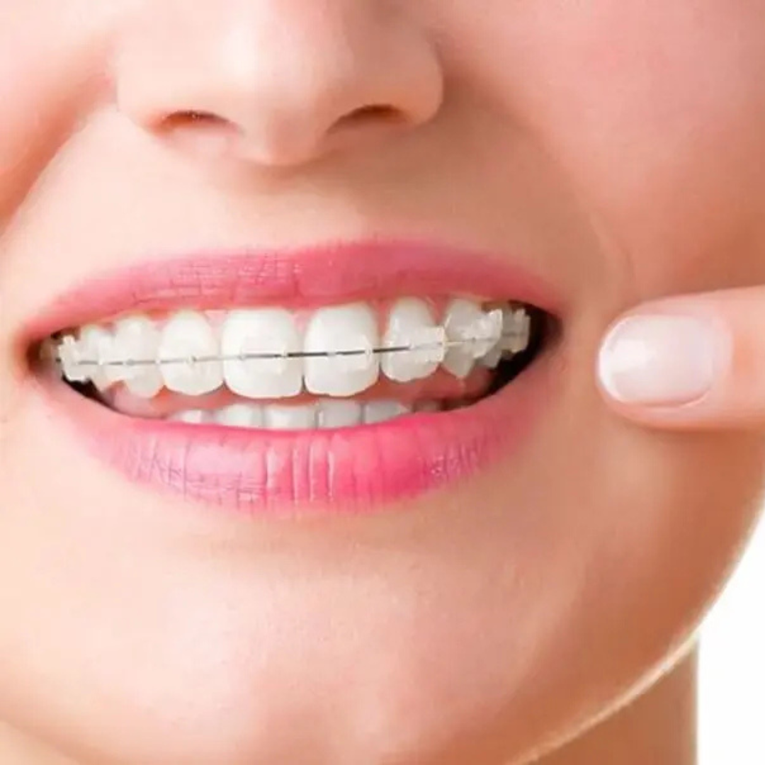 Self Ligating / Damon Braces